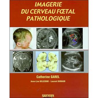 Imagerie du cerveau foetal pathologique