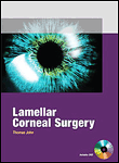 Lamellar corneal surgery