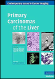 Primary carcinomas of the liver