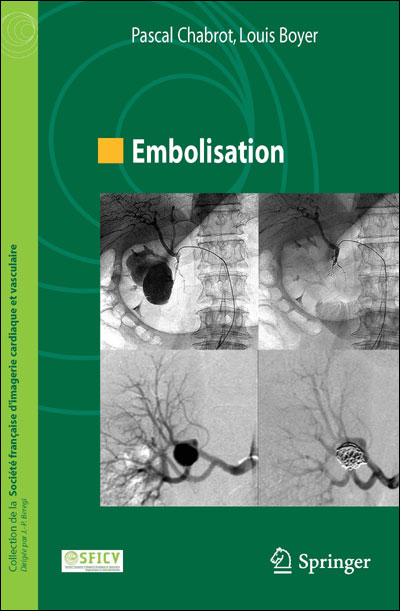 Embolisation