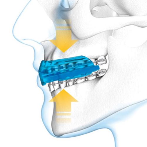 Shock Doctor protège-dents Bracesenior silicone bleu - Accessoire sports de  combat - Achat & prix