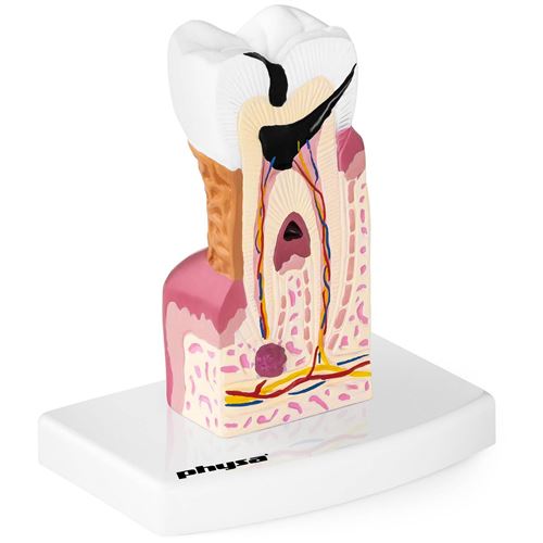Maquette Anatomique Dents Humaines Anatomie Humaine Modèle Dent Malade Carie 6:1