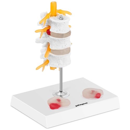 Modèle Anatomique Hernie Discale Lombaire – Agrandissement 1.5x, PVC Médical, Pour Enseignement Ou Décoration