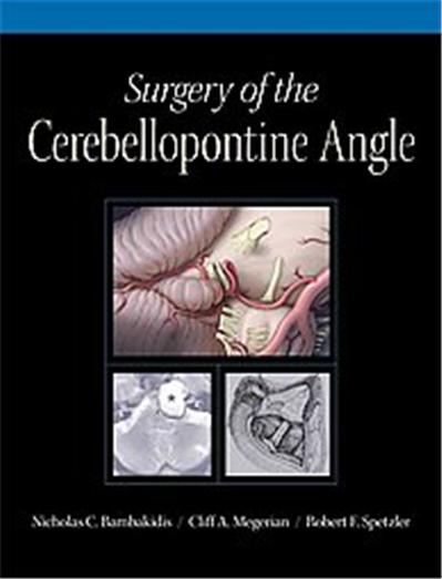 Surgery of the Cerebellopontine Angle