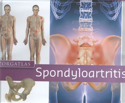 Zorgatlas Spondyloartritis