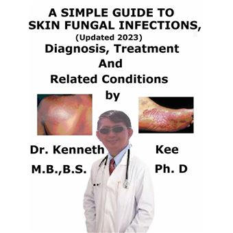 A Simple Guide to Medical Conditions - A Simple Guide to Skin Fungal ...