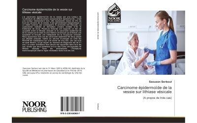 Carcinome epidermoide de la vessie sur lithiase vesicale -