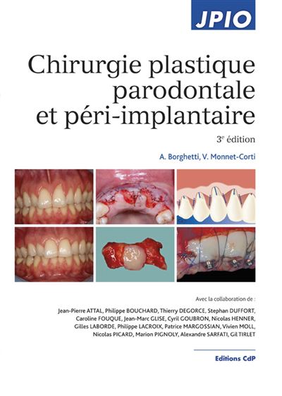 Chirurgie plastique parodontale