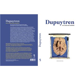 Dupuytren