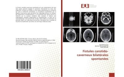 Fistules carotido-caverneux bilaterales spontanees