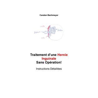 Traitement d'une Hernie Inguinale Sans Opération!