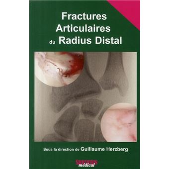 Fractures articulaires du radius distal