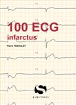 100 ECG autour de l'infarctus