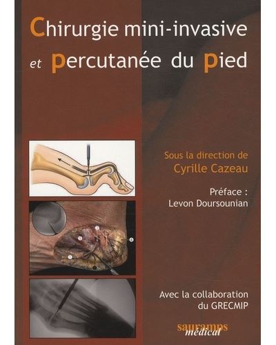 Chirurgie Mini Invasive Et Percutanee Du Pied Tome Broch Cyrille Cazeau Cazeau