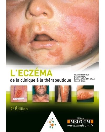 L eczema. de la clinique au traitement. 2 ed