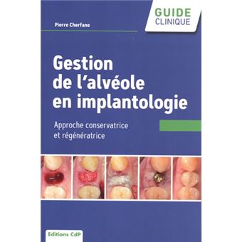 Gestion de l'alvéole en implantologie