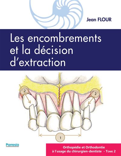 Les encombrements et la décision d'extraction