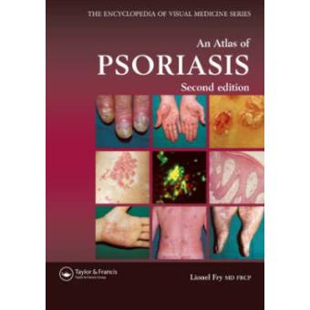 An Atlas of Psoriasis - Hardback - 2004 - 1