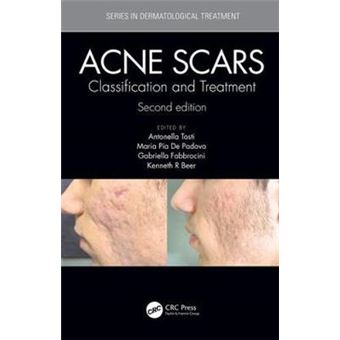Acne Scars - 1