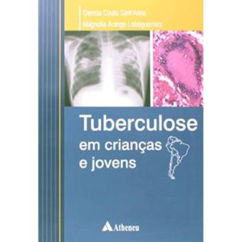 Tuberculose Em Crianças E Jovens - 1