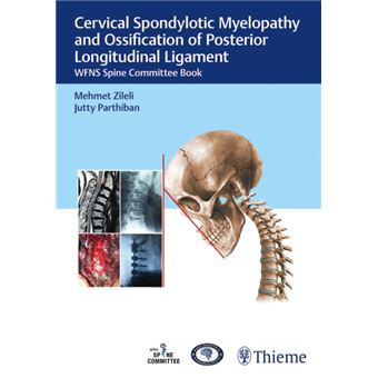 Cervical Spondylotic Myelopathy And Ossification Of Posterior ...