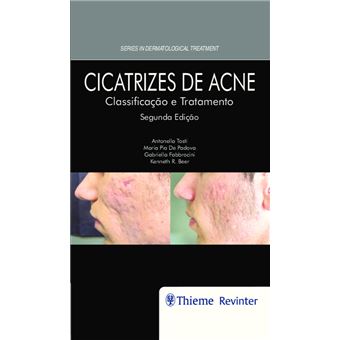 Cicatrizes de Acne: Classificação e Tratamento - 1