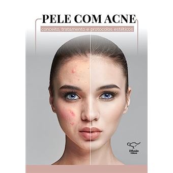 Pele Com Acne - 1