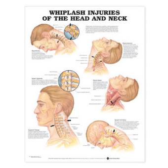 Whiplash Injuries of the Head and Neck Anatomical Chart - 1