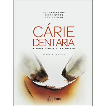 Cárie Dentaria: Fisiopatologia e Tratamento