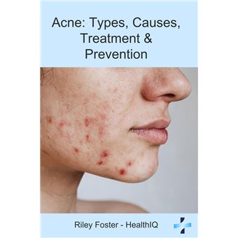 Acne: Types, Causes, Treatment & Prevention - 1