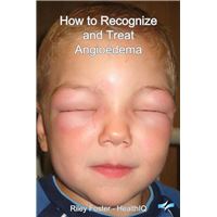 How to Recognize and Treat Angioedema